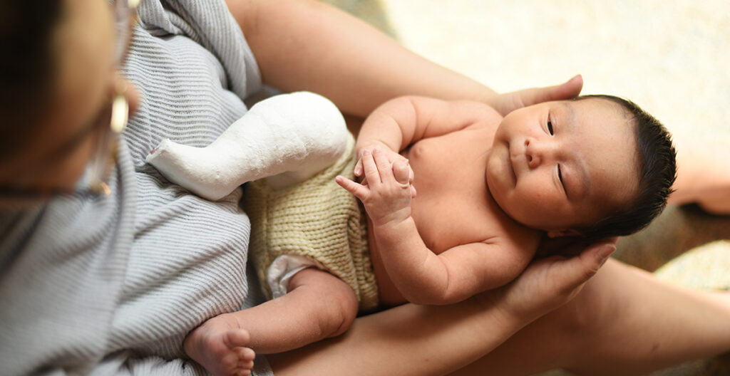 a baby being casted for clubfoot